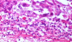 Herpes humana existe há pelo menos 2,5 mil anos, mostra estudo